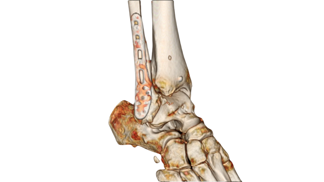 患者第二次手术后右踝ct三维重建影像在顺利出院后,为了表达这份