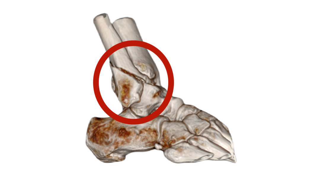 患者**次手术后右踝ct三维重建影像经过一段时间的精心治疗和护理